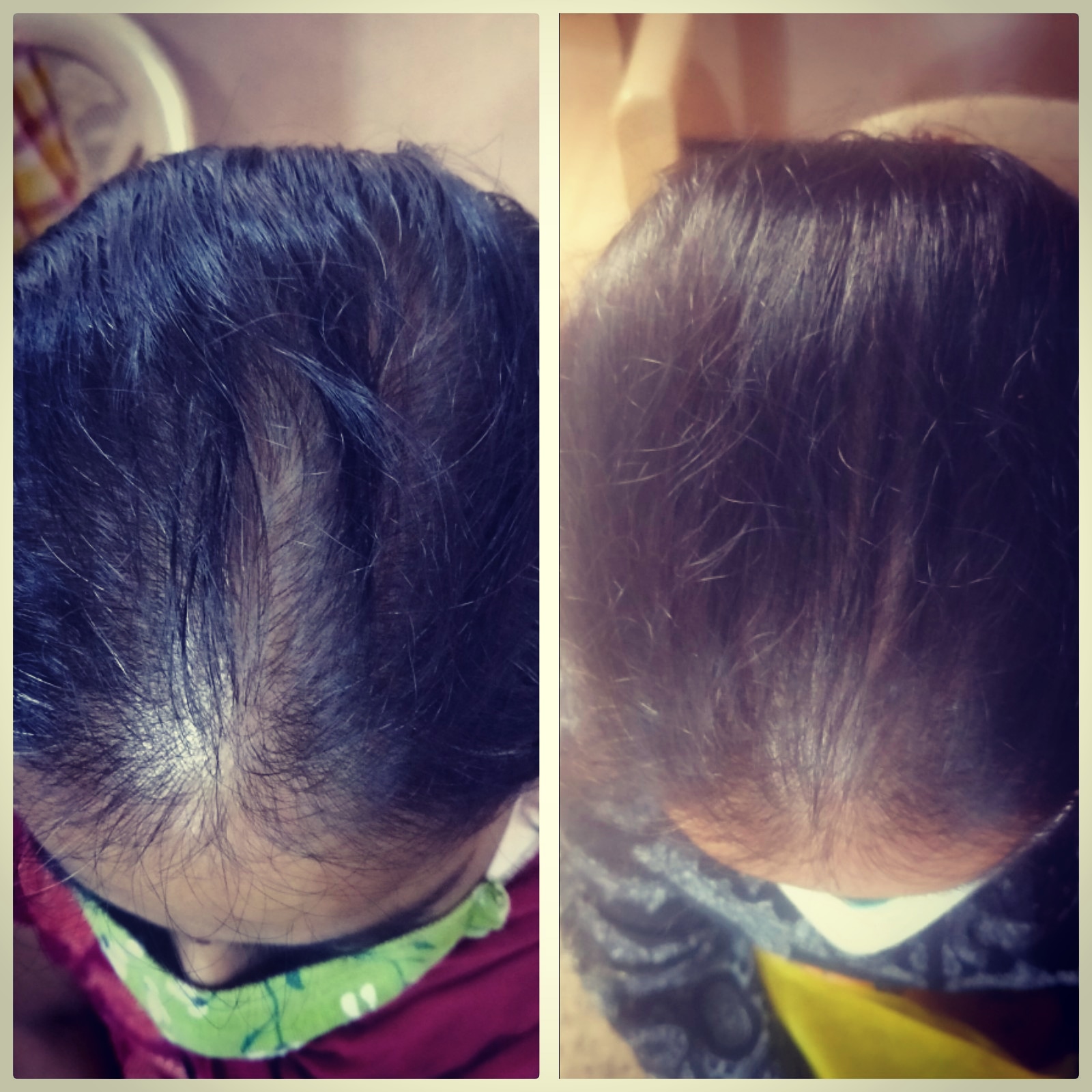 Hair Loss Treatment