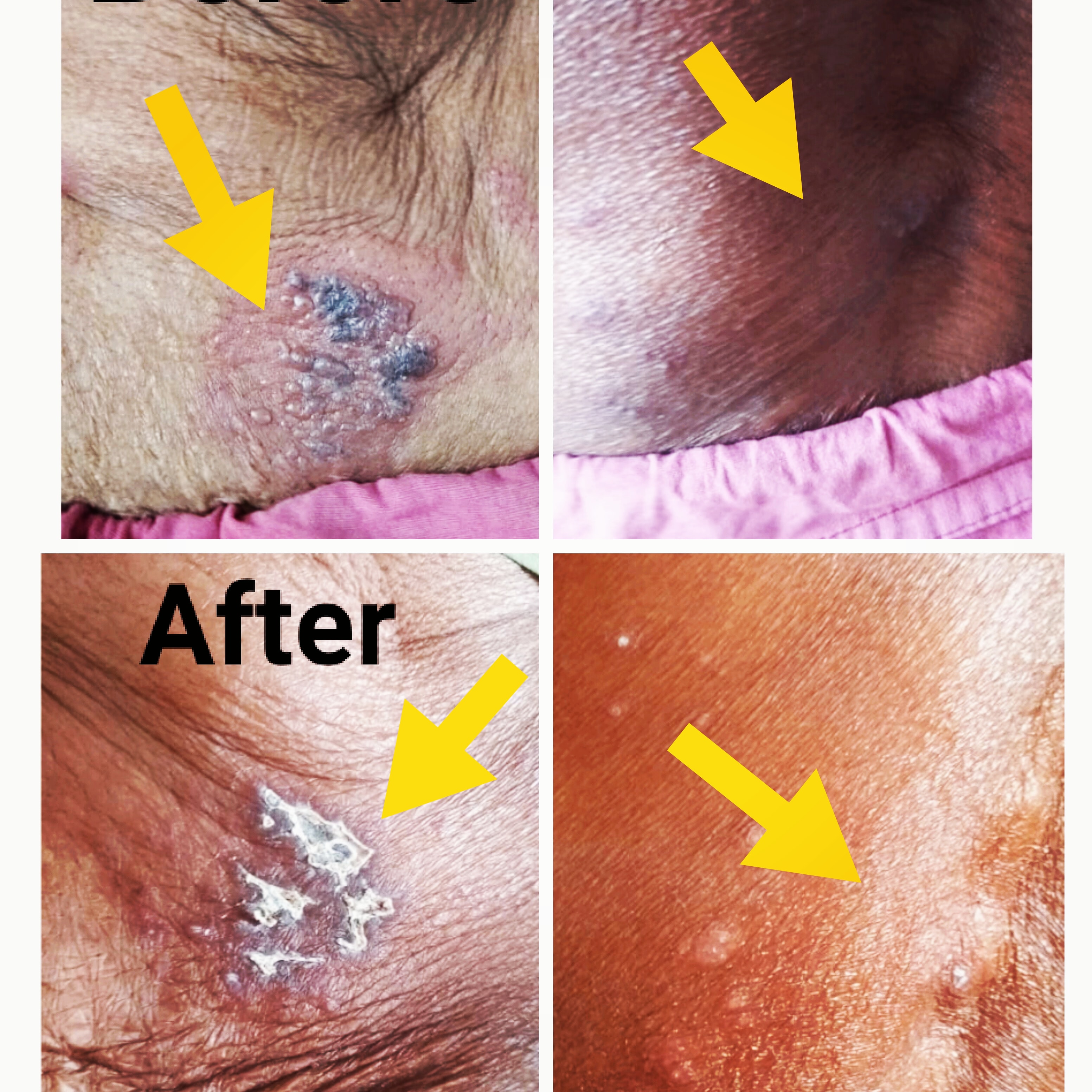 Herpes Zoster Treatment