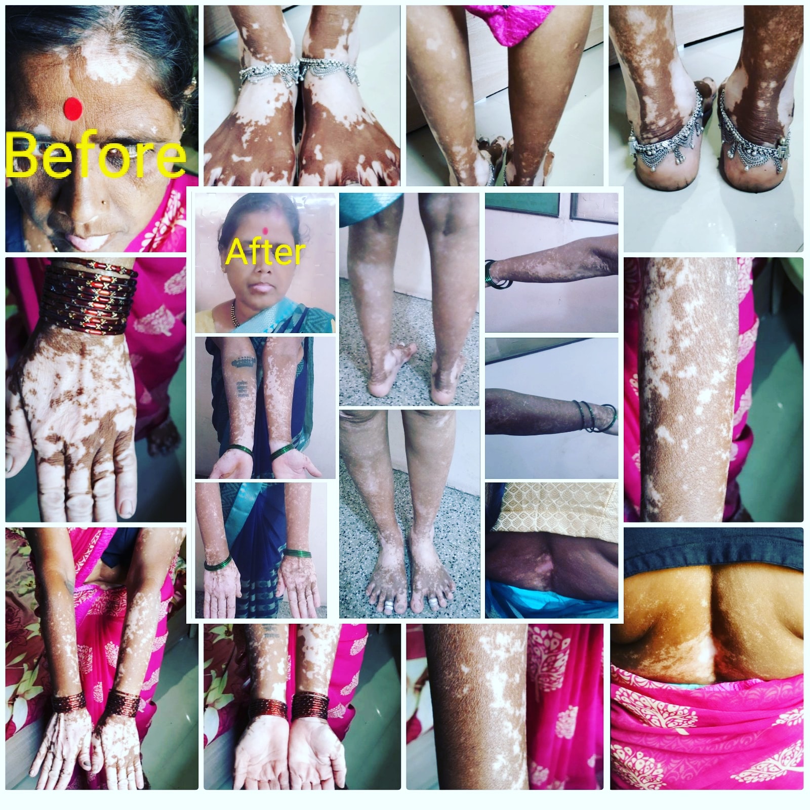 Leucoderma Treatment